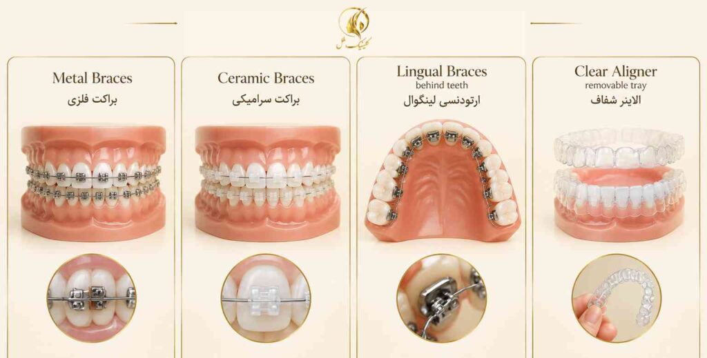مقایسه براکت فلزی، سرامیکی، لینگوال و الاینر شفاف