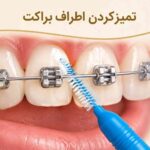تمیزکردن اطراف براکت ارتودنسی با مسواک بین&zwnj;دندانی