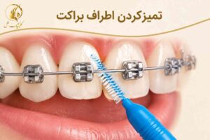 تمیزکردن اطراف براکت ارتودنسی با مسواک بین&zwnj;دندانی