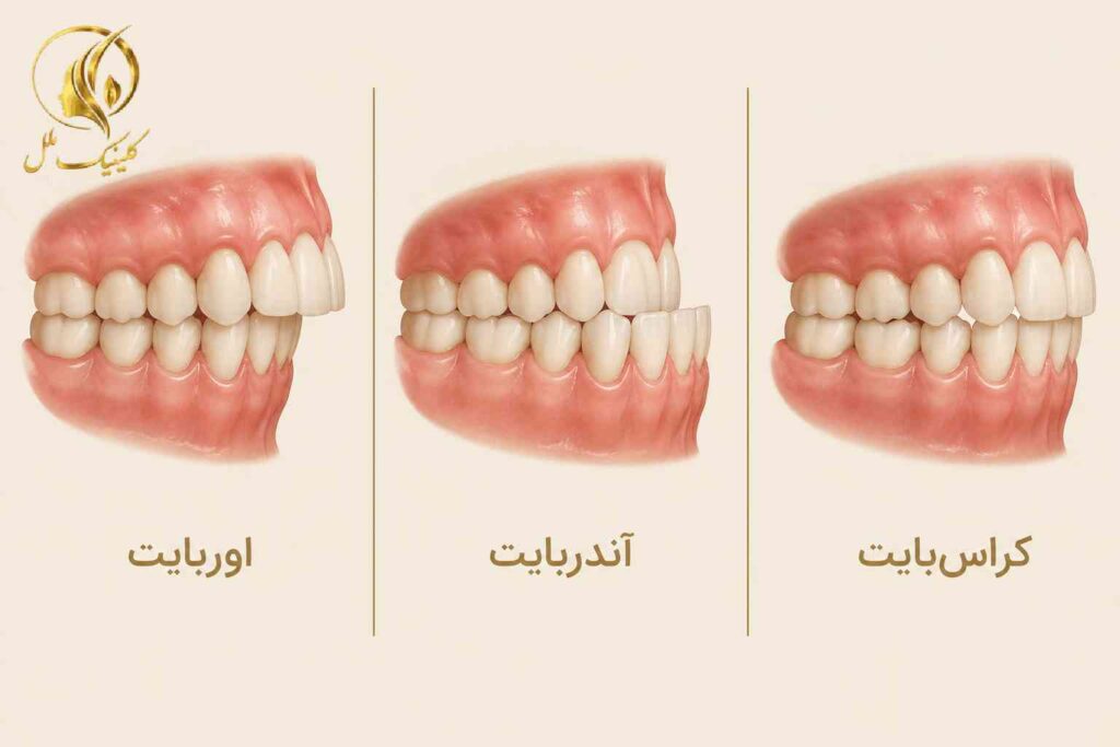نمای آموزشی تفاوت اوربایت، آندربایت و کراس&zwnj;بایت
