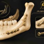 نمای شماتیک تثبیت استخوان فک پس از جراحی اصلاحی