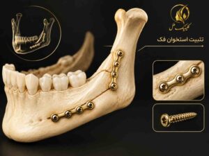 نمای شماتیک تثبیت استخوان فک پس از جراحی اصلاحی