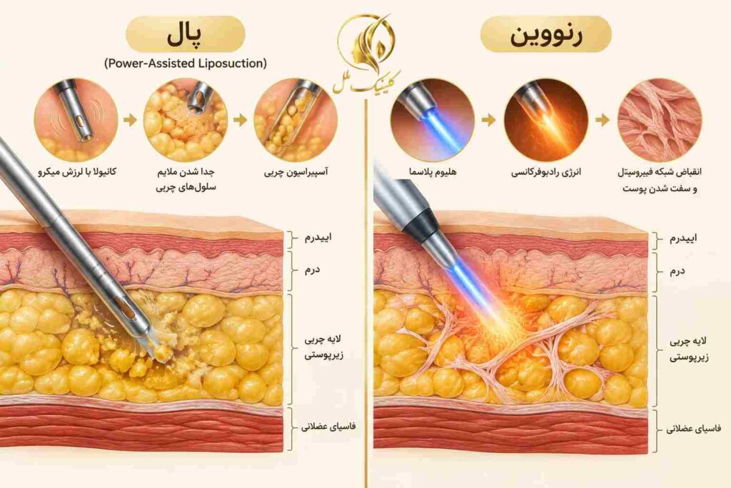 مقایسه عملکرد پال در تخلیه چربی و رنووین در اثرگذاری بر بافت زیرجلدی