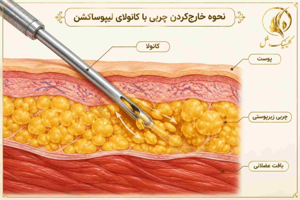 تصویر آموزشی نحوه خارج&zwnj;کردن چربی با کانولای لیپوساکشن