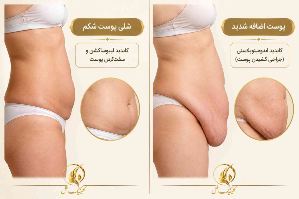 تفاوت شلی پوست شکم و پوست اضافه در ارزیابی روش پیکرتراشی