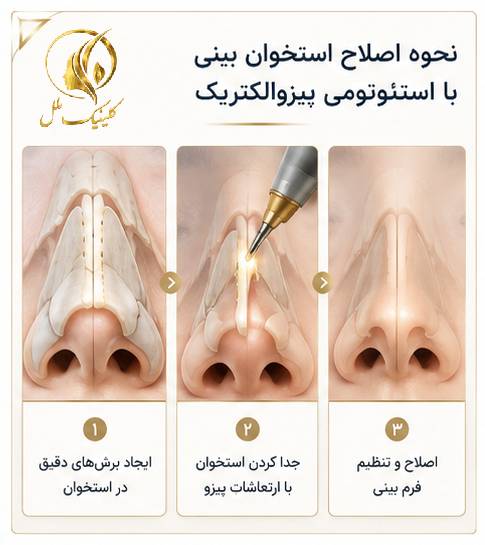 نحوه اصلاح استخوان بینی با استئوتومی پیزوالکتریک