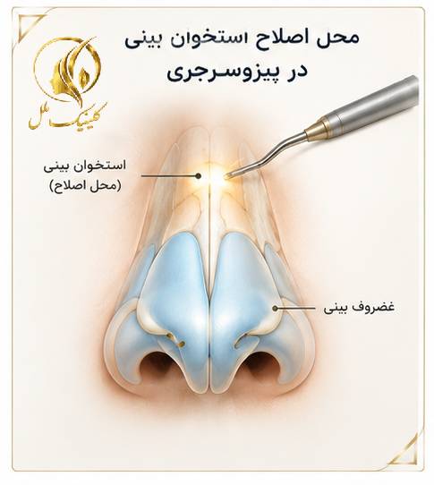 محل اصلاح استخوان بینی در پیزوسرجری