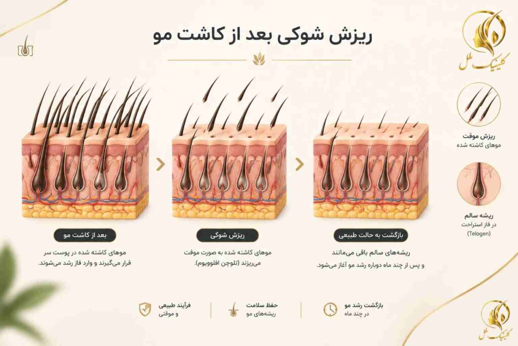 shock-loss-after-hair-transplant-01 تصویر آموزشی ریزش شوکی بعد از کاشت مو