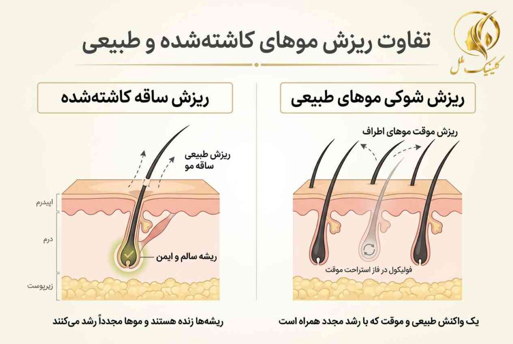 shock-loss-after-hair-transplant-02 تفاوت ریزش ساقه موهای کاشتهشده و ریزش شوکی موهای طبیعی