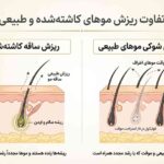 تفاوت ریزش ساقه موهای کاشته&zwnj;شده و ریزش شوکی موهای طبیعی