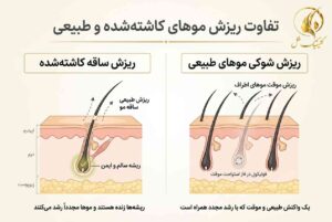 تفاوت ریزش ساقه موهای کاشته&zwnj;شده و ریزش شوکی موهای طبیعی