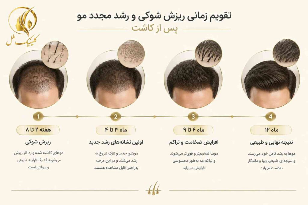 shock-loss-after-hair-transplant-03 تقویم زمانی ریزش شوکی و رشد مجدد مو پس از کاشت