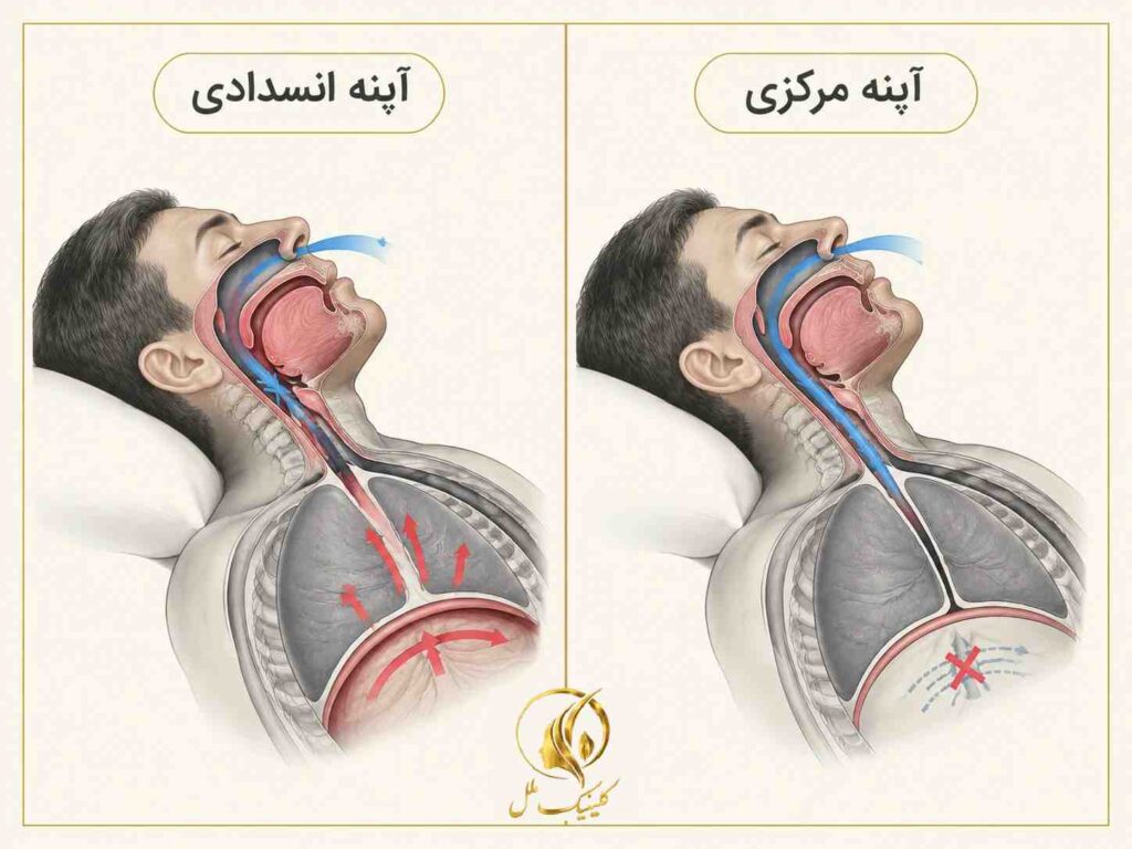 مقایسه شماتیک آپنه انسدادی و آپنه مرکزی خواب