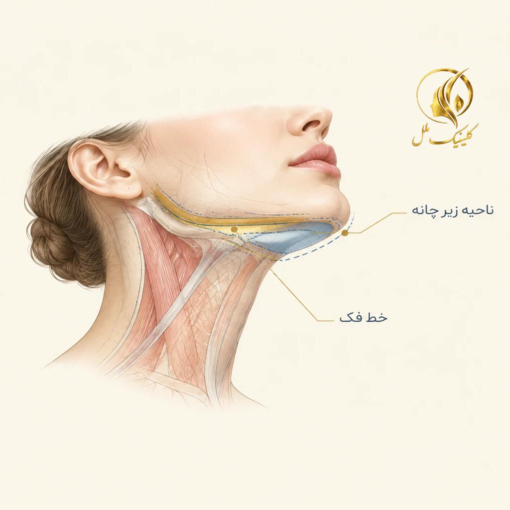 super-contour-double-chin01 نمای شماتیک ناحیه زیر چانه و خط فک در سوپر کانتور غبغب