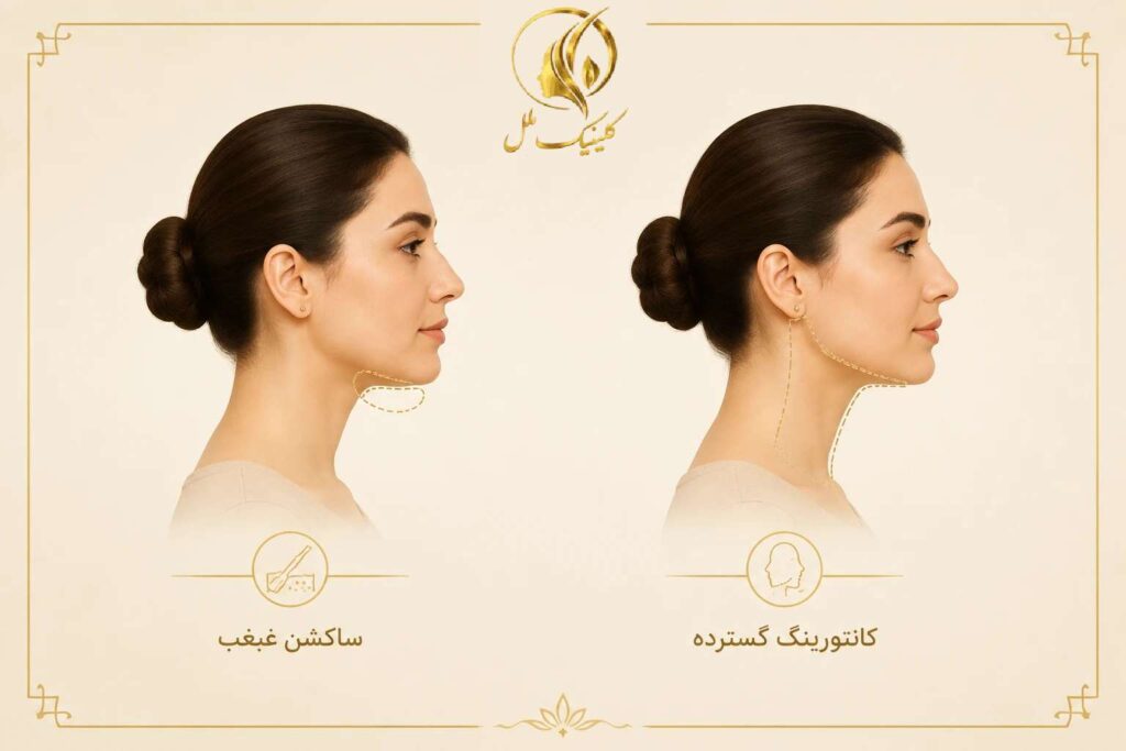 super-contour-double-chin02 مقایسه شماتیک محدوده ساکشن غبغب با کانتورینگ گستردهتر پایین صورت