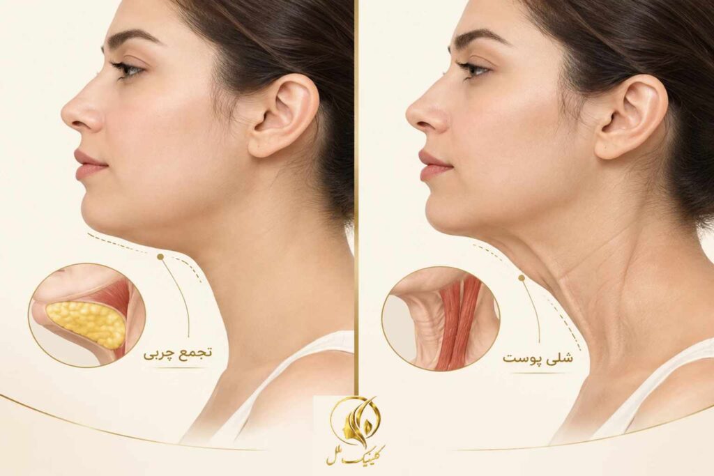 super-contour-double-chin03 تصویر آموزشی تفاوت تجمع چربی زیر چانه و شلی پوست گردن