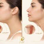 تصویر آموزشی تفاوت تجمع چربی زیر چانه و شلی پوست گردن