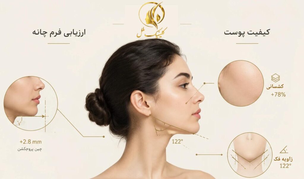 super-contour-double-chin04 ارزیابی فرم چانه، خط فک و وضعیت پوست پیش از سوپر کانتور