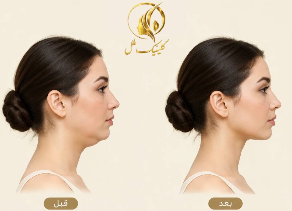 super-contour-double-chin06 نمونه واقعی قبل و بعد سوپر کانتور غبغب با شرایط تصویربرداری مشابه