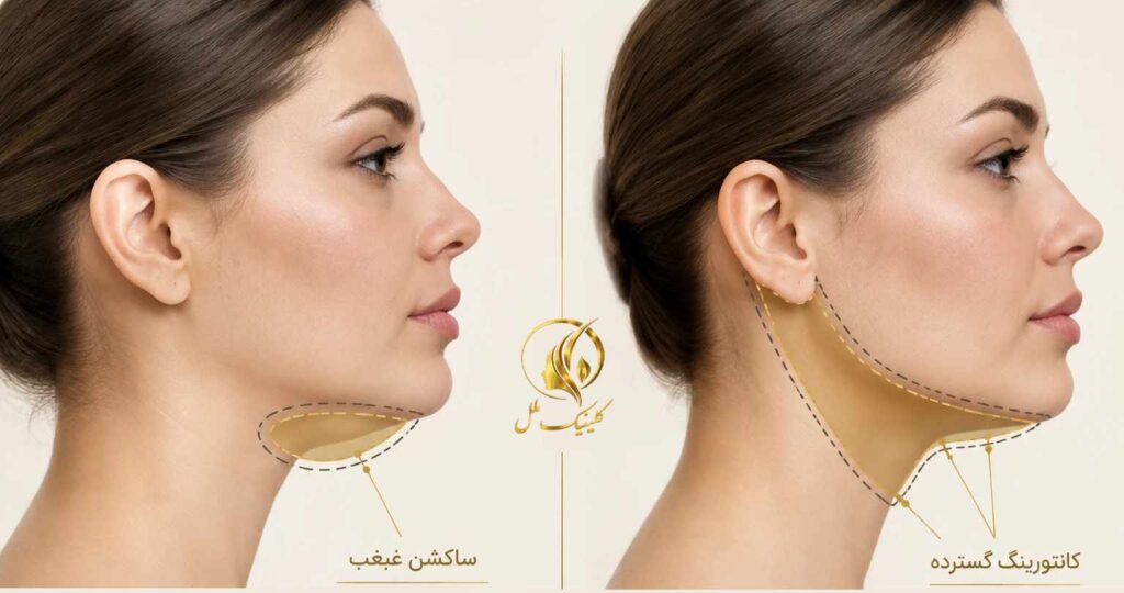 super-contour-double-chin07 زاویه و محل مورد تمرکز در کانتورینگ غبغب