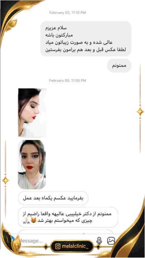 رضایت بعد از عمل زیبایی بینی